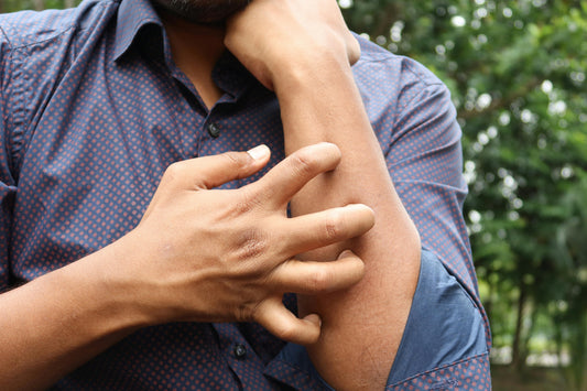 "Close-up of a man scratching his arm due to eczema flare-up. Learn natural remedies and organic skincare tips to relieve eczema irritation at BonafideOrganics.com."
